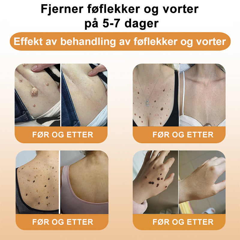🐆Turoment™ Bie Gift Behandlingskrem (🔥Siste dag, 80 % rabatt)