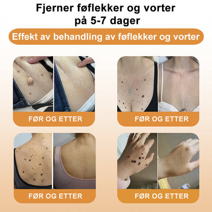 🐆Turoment™ Bie Gift Behandlingskrem (🔥Siste dag, 80 % rabatt)