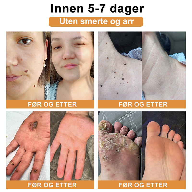 🐆Turoment™ Bie Gift Behandlingskrem (🔥Siste dag, 80 % rabatt)